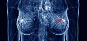 CBD redukuje ból oraz spowalnia rozwój raka piersi, GrubyLoL.com